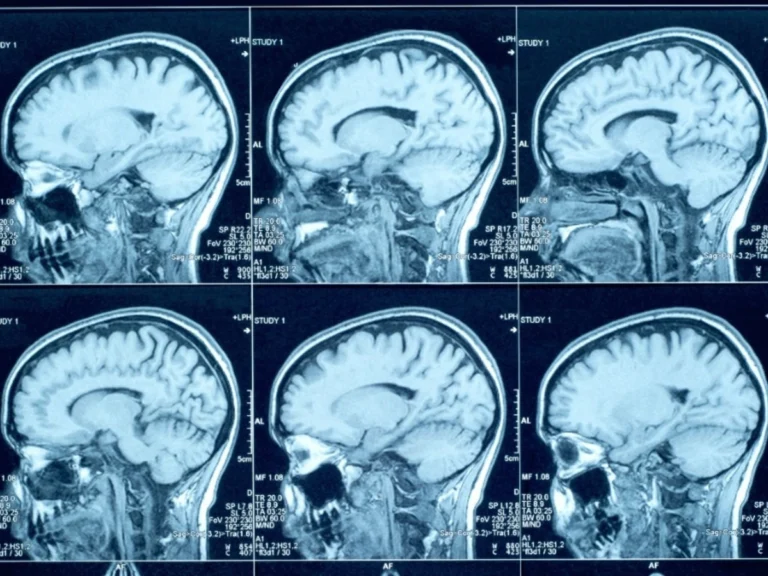 Doença de Creutzfeldt-Jakob: entenda a condição neurodegenerativa rara e progressiva